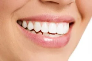 In-Office Whitening image